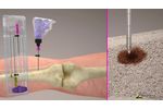 OmniBone Bone Biopsy Kit with Power - Video