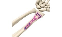 Miraclus - Model VALP - Two Column Volar Plate Distal Radius System