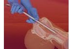 Tracheal Stent Delivery - Cares - Video