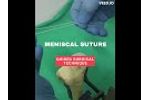 Meniscal Suture - Video