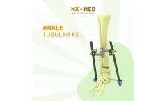 Nafx NX-MED - Ankle External Fixators
