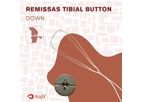 Nafx Adjustable Button - Tibial Side Manipulation - Remissas Hanger