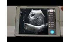 Double Probes Wireless Handheld Ultrasound Scanner-D5CE - Video