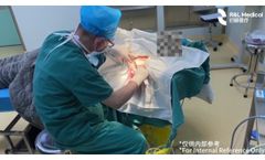 Axillary Osmidrosis Surgery with Hydrosurgery Debridement System - Video