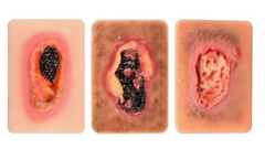 Ultrassist - Pocket-Sized Necrotic Tissue Wound Simulation Model Set