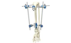 OrthoProMed - Proximal Tibia External Fixator