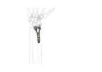 GEMINUS - Distal Radius Volar Plate