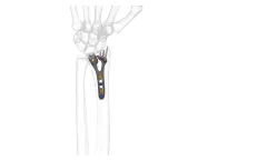 GEMINUS - Distal Radius Volar Plate