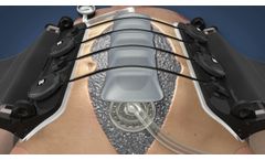 AbClo System, Instructions for Use - Video