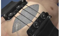 AbClo - Negative Pressure Wound Therapy and Traction Device