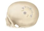 Bioplate - Osteopore Bioresorbable Bone Scaffold for Craniotomies