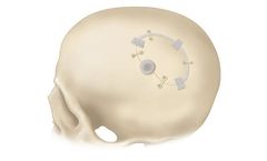 Bioplate - Osteopore Bioresorbable Bone Scaffold for Craniotomies