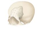 CRANIOFIT - Customized PEEK Cranial Plates for Complex Cranioplasty