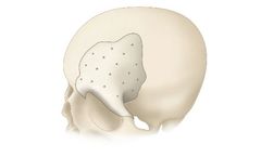 CRANIOFIT - Customized PEEK Cranial Plates for Complex Cranioplasty