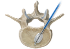 Osteo-site - Vertebral Balloon