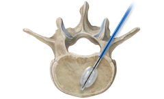 Osteo-site - Vertebral Balloon
