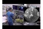 Pancreatic Cyst Assessment - Case 2 Video