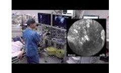 Pancreatic Cyst Assessment - Case 2 Video
