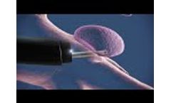 Cellvizio in Lung Nodules Video