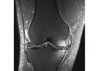 Zimmer - Chronic Bone Marrow Lesions (BML)