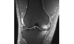 Zimmer - Chronic Bone Marrow Lesions (BML)