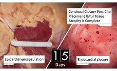 AtriClip FLEX∙V™ Device Animation - Video