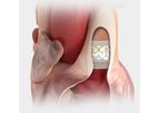 Edwards Sapien - Model XT - Transcatheter Heart Valves for Predictable Deployment