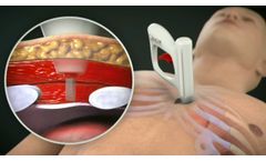 AtaCor Medical - MedTech Innovator Best Competition - Video