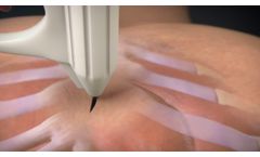 AtaCor Medical Temporary Substernal Pacing - Video