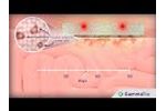GammaTile Therapy: How It Works - Video