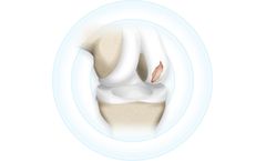 Hyalex - Human Cartilage Restoring