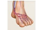 LimFlow - Chronic Limb- Threatening Ischemia (CLTI) Technology
