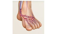 LimFlow - Chronic Limb- Threatening Ischemia (CLTI) Technology