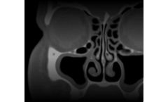 PROPEL - Sinus Implants