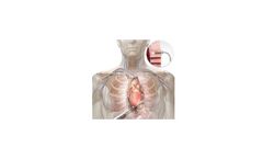 CardioGenesis - Cardiac Laser Therapy