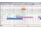 Natus SleepWorks - PSG Software