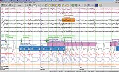 Natus SleepWorks - PSG Software