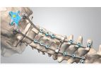 Centurion - Posterior Occipital Cervico-Thoracic System (POCT)