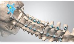 Centurion - Posterior Occipital Cervico-Thoracic System (POCT)