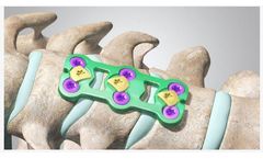 Cetra - Anterior Cervical Plate System