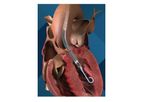 Impella - Model LD -5.0 - Minimally Invasive or Surgically Implanted Heart Pumps