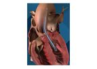 Impella - Model 5.5 - Minimally Invasive Heart Pump with Smart Assist