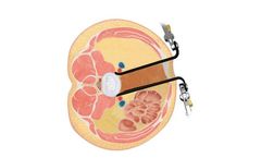 Mars - Model ALIF - Lateral Retractor