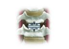 Secure - Model C - Cervical Artificial Disc