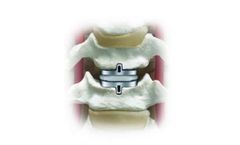 Secure - Model C - Cervical Artificial Disc