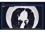 Arterys - Version Lung AI - Assisted Chest CT Analysis Software