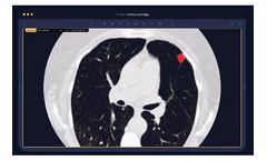 Arterys - Version Lung AI - Assisted Chest CT Analysis Software