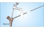 PRECICE Antegrade Femur Animation - Video