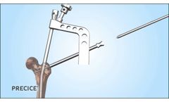 PRECICE Antegrade Femur Animation - Video