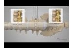 NuVasive® XLIF® Patient Animation - Video